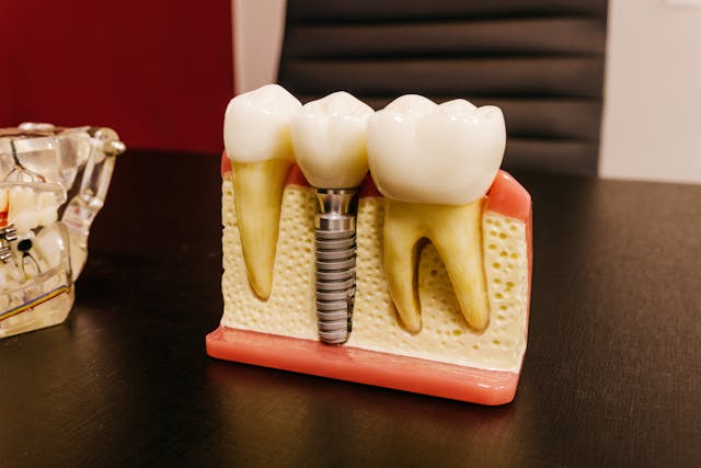 How Dental Implants in Marietta, GA Can Restore Your Smile and Confidence - ArticleWaves